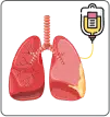 chemotherapy