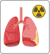 radiation therapy
