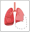 Lung Surgery