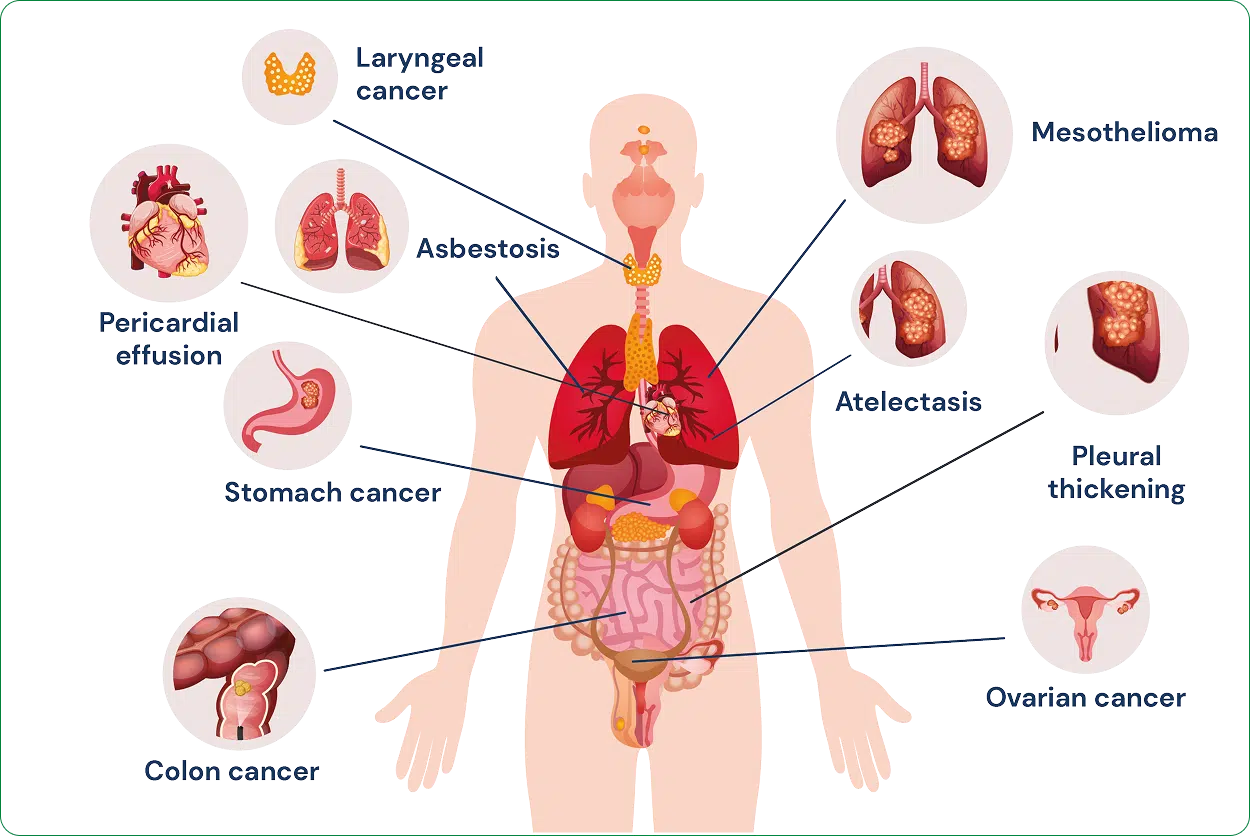 Effects of asbestos exposure