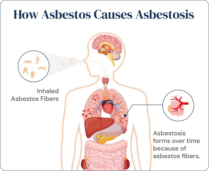 How asbestos causes asbestosis chart